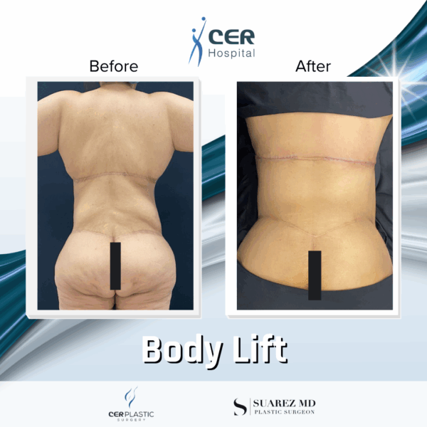 Body Lift - 05063 - Image 6