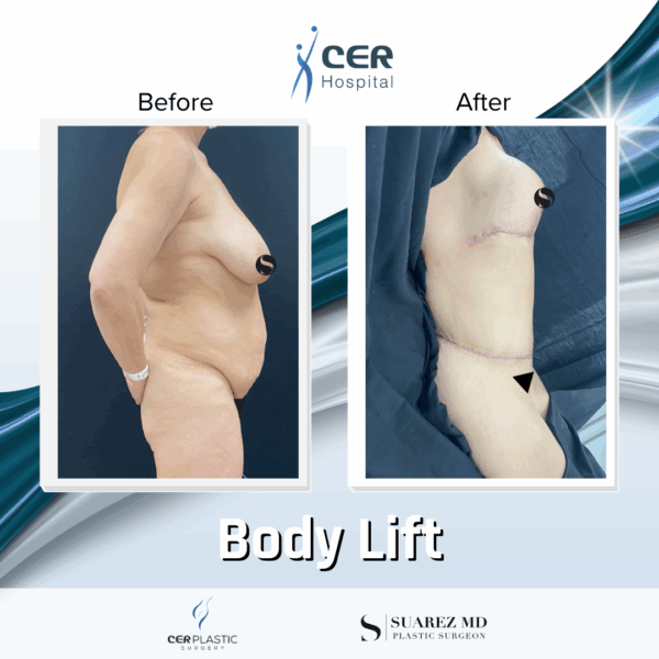 Body Lift - 15053 - Image 8