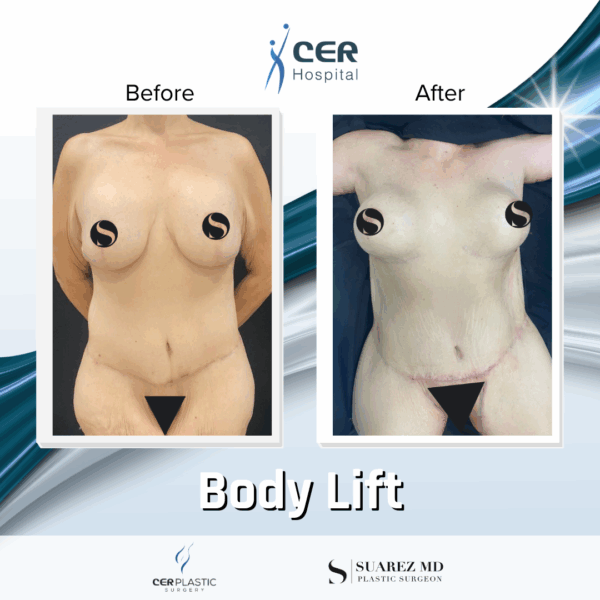 Body Lift - 12063 - Image 8