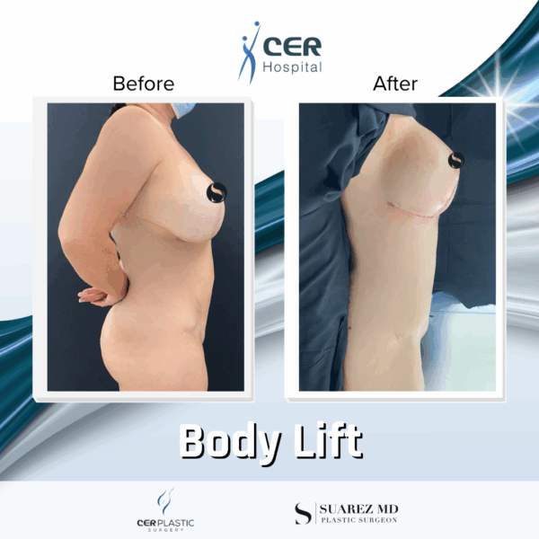 Body Lift - 30063 - Image 7