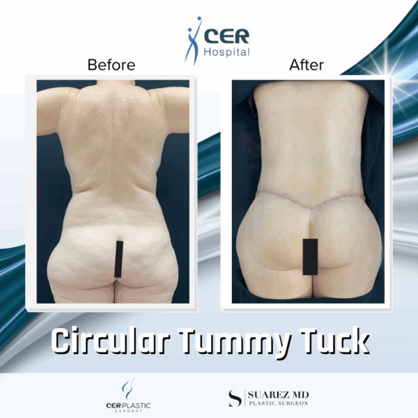 Circular Tummy Tuck - 05073 - Image 7