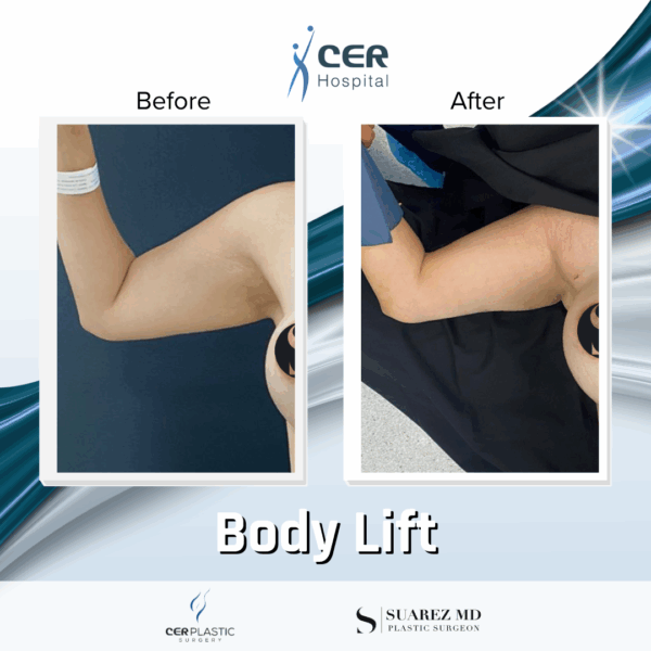 Body Lift - 14073 - Image 8