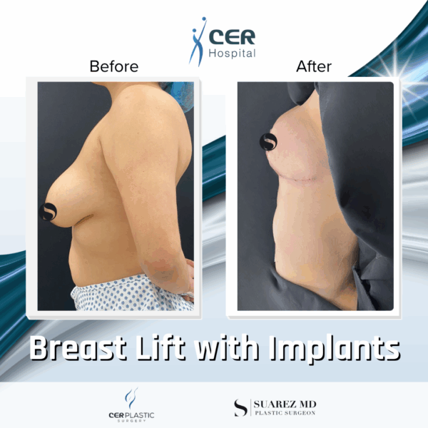 Breast Lift with Implants - 30063 - Image 7