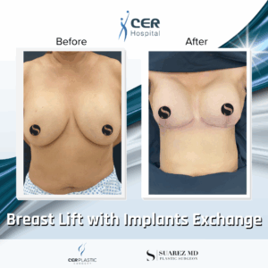Breast Lift with Implant Exchange – 09063