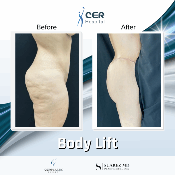 Body Lift - 039 - Image 7