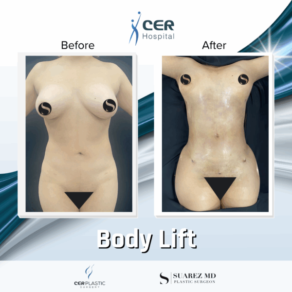 Body Lift - 30053 - Image 7