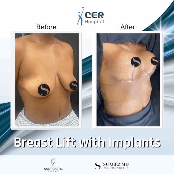 Breast Lift with Implants - 02063 - Image 7