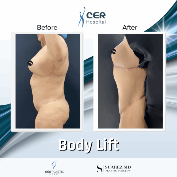 Body Lift - 05063 - Image 7
