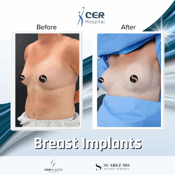 Breast Implant - 05063 - Image 7