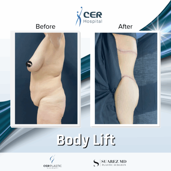 Body Lift - 15053 - Image 9