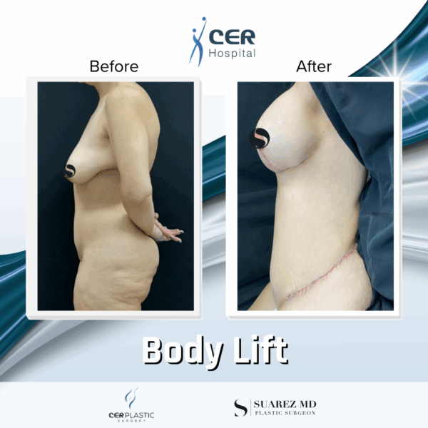 Body Lift - 039 - Image 8