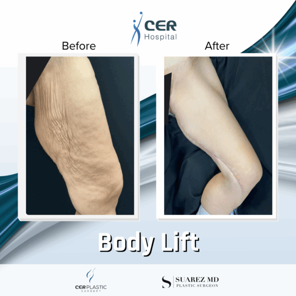 Body Lift - 019 - Image 8