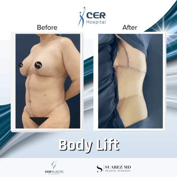 Body Lift - 05063 - Image 8