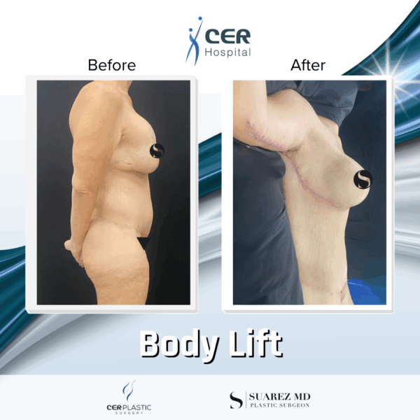 Body Lift - 12063 - Image 9