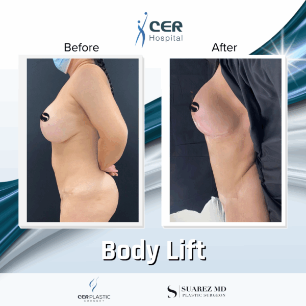 Body Lift - 30063 - Image 8