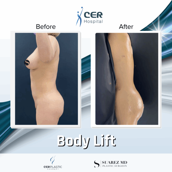 Body Lift - 30053 - Image 8