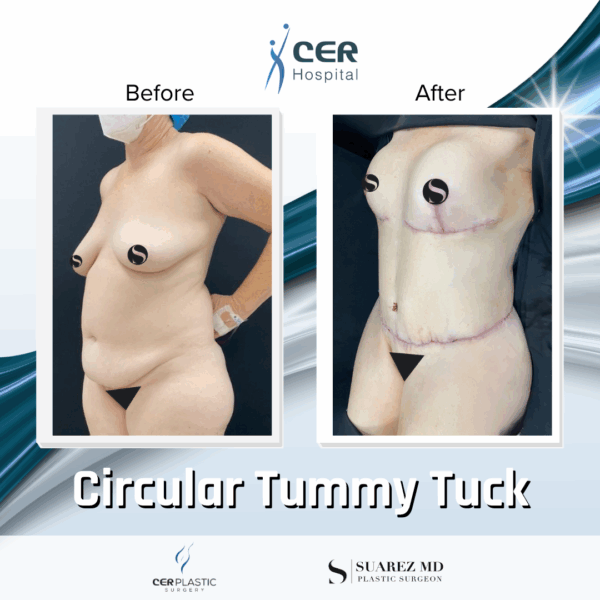 Circular Tummy Tuck - 05073 - Image 8
