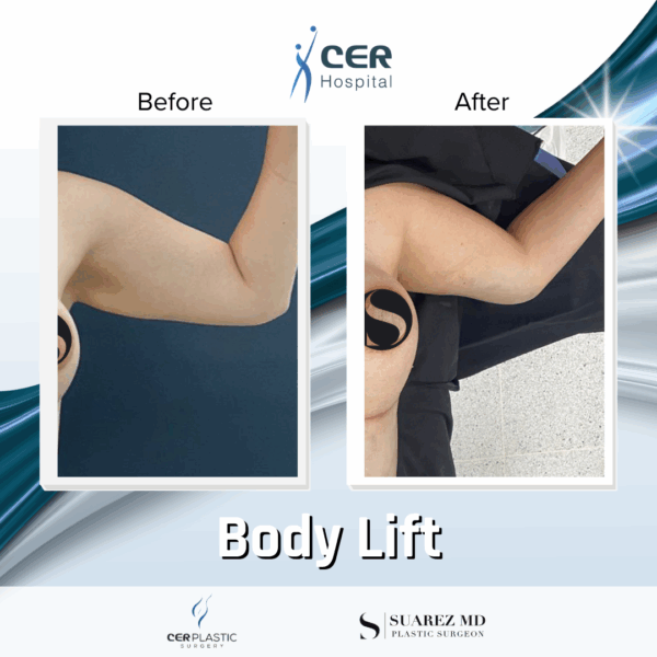 Body Lift - 14073 - Image 9