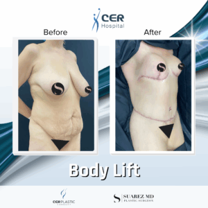 Body Lift – 15053