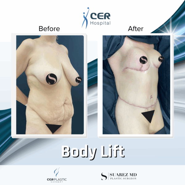 Body Lift - 15053