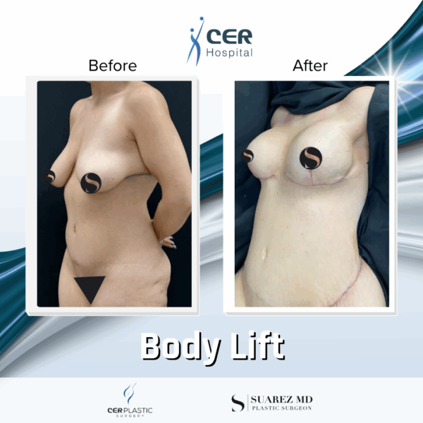 Body Lift - 039 - Image 10