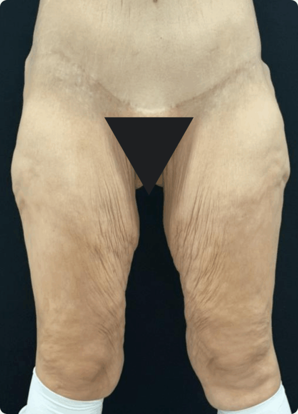 Body Lift - 019 - Image 3