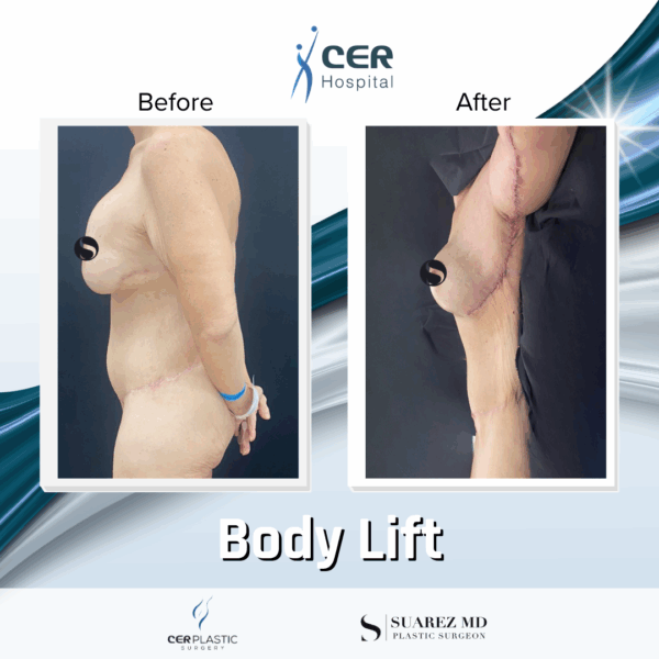 Body Lift - 12063 - Image 10