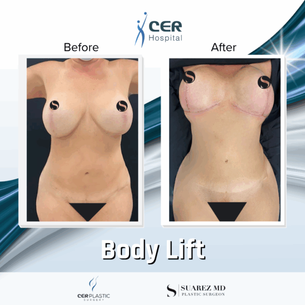 Body Lift - 30063 - Image 9
