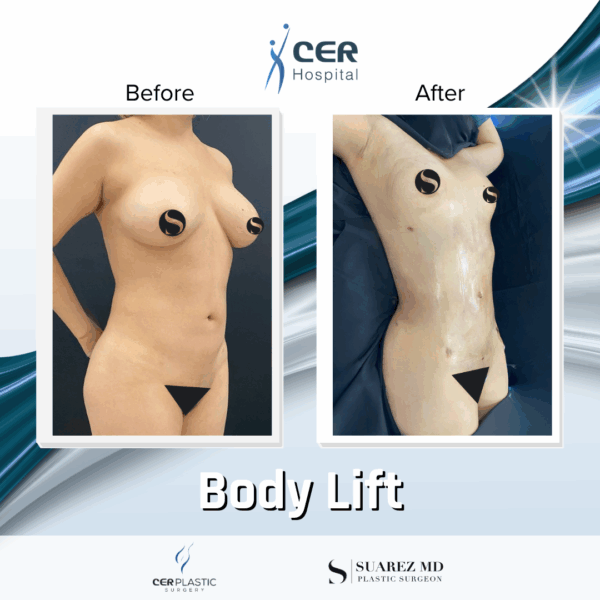Body Lift - 30053 - Image 9