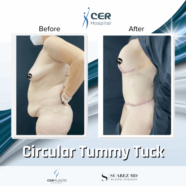 Circular Tummy Tuck - 05073 - Image 9