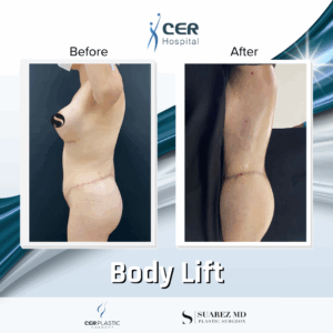 Body Lift – 14073
