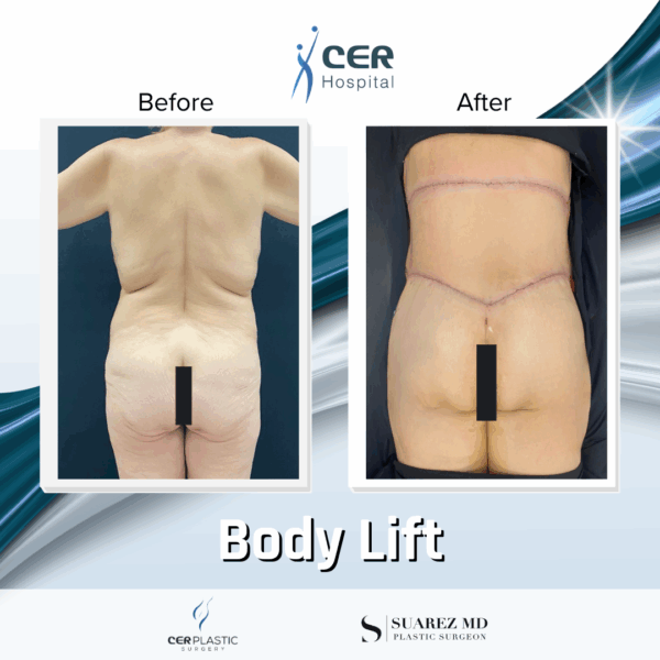 Body Lift - 15053 - Image 10