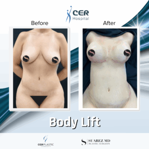 Body Lift – 039