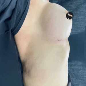 Implant Exchange – 09063