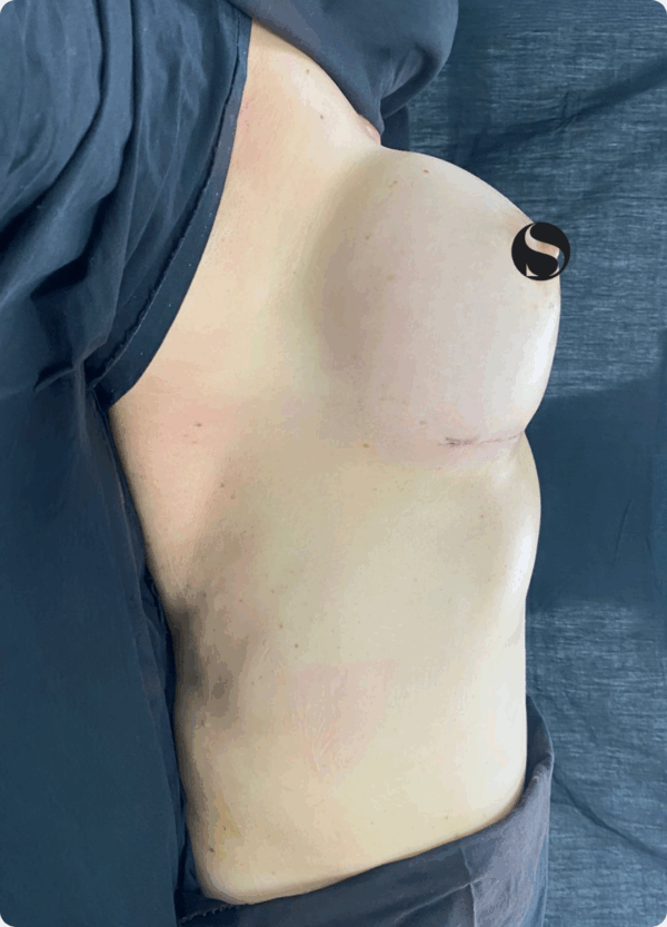 Implant Exchange - 09063 - Image 2