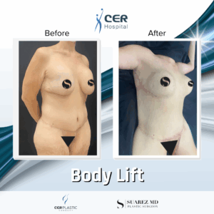 Body Lift – 12063