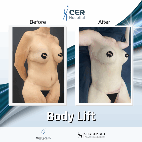 Body Lift - 12063