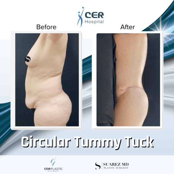 Circular Tummy Tuck - 05073 - Image 10
