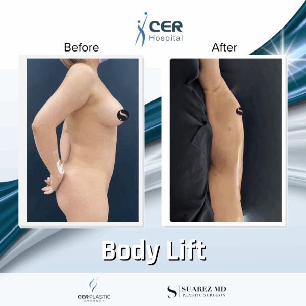 Body Lift - 30053 - Image 10