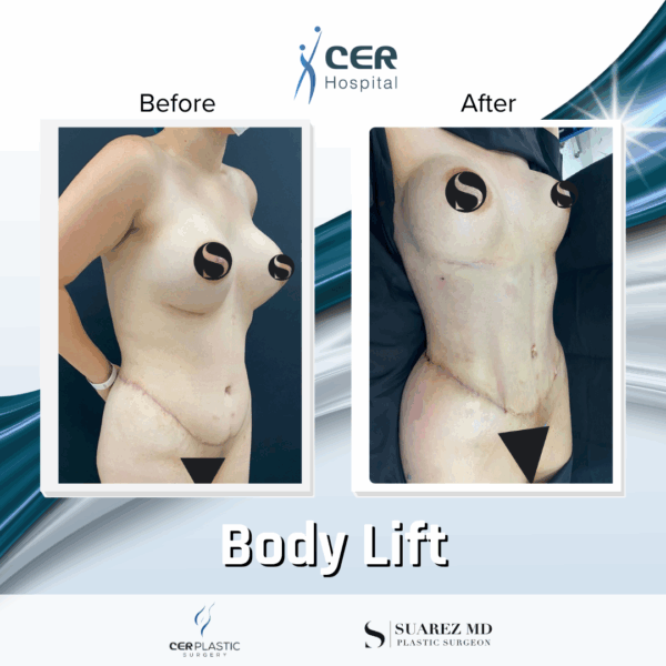 Body Lift - 14073 - Image 10