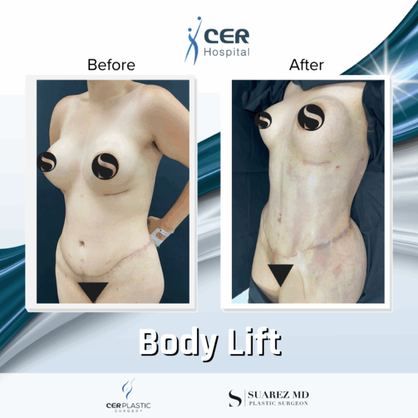 Body Lift - 14073 - Image 11