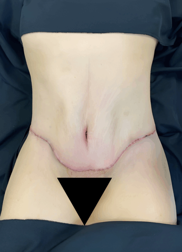 Body Lift -220925 - Image 3