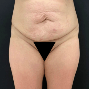 Body Lift -220925