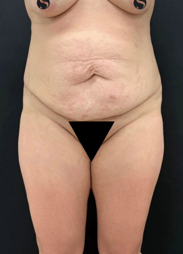 Body Lift -220925 - Image 2