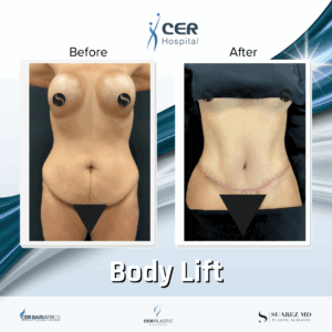 Body Lift- 061025