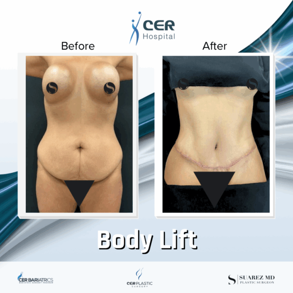 Body Lift- 061025