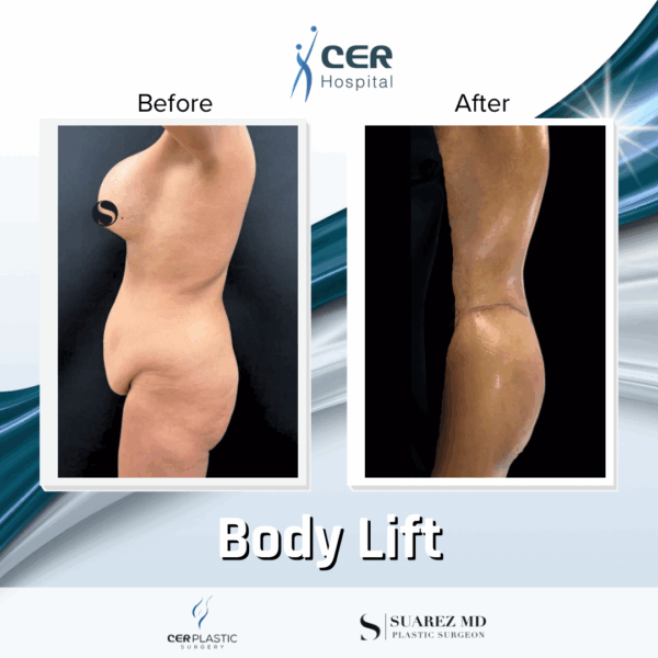 Body Lift- 061025 - Image 4