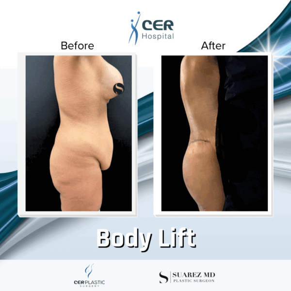 Body Lift- 061025 - Image 5