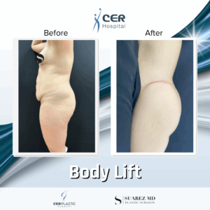 Body Lift -220925