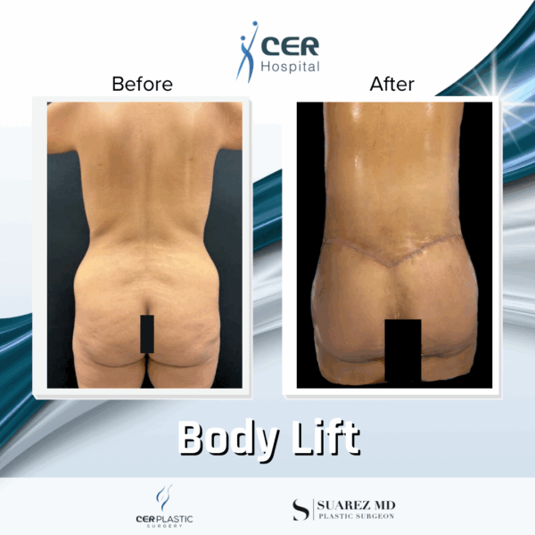 Body Lift- 061025 - Image 6